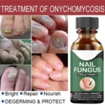 Fast Nail Fungus Treatment Serum – Nail Repair Essence for Finger & Toenail Care (All-Natural Formula) - Image 5