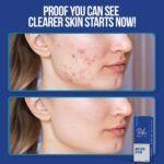 Wiki Special Anti Acne Serum | Clears Acne, Soothes Skin & Fights Blemishes (30ml) - Image 4